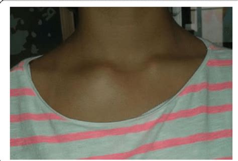 Painful Swelling Of The Sternal End Of The Right Clavicle Download