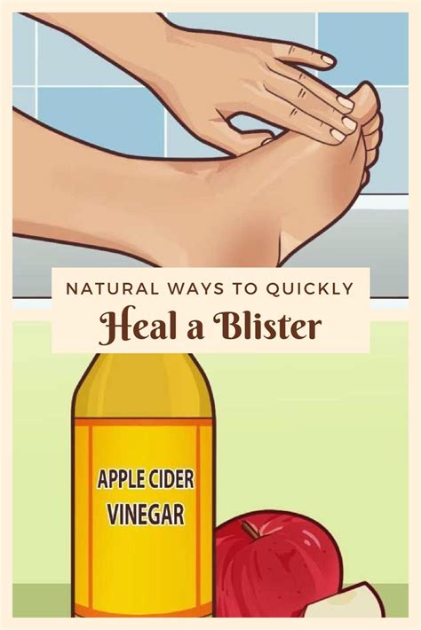 Natural Ways To Quickly Heal A Blister How To Heal Blisters Blister
