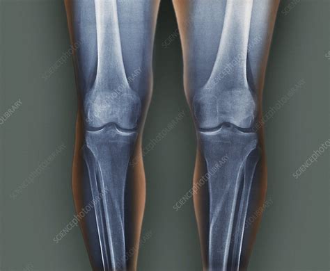 Normal Knees X Rays Stock Image C0155086 Science Photo Library