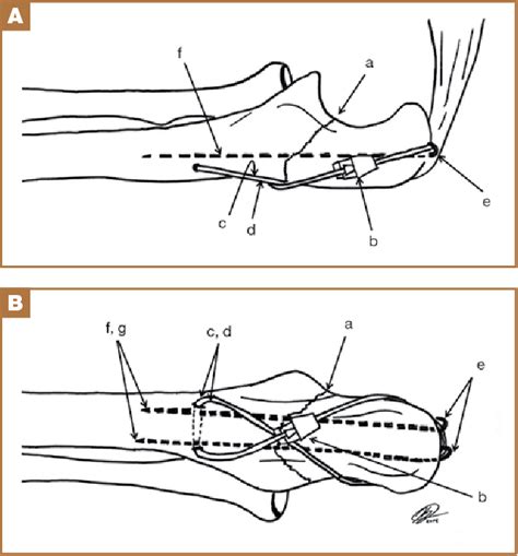 Figure 2 From Technique Using Isoelastic Tension Band For Treatment Of