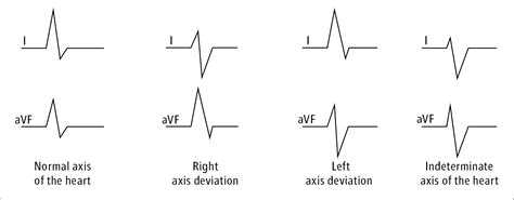 Figure 0312699 Determination Of The Electrical Axis Of The Heart