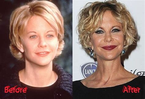 Meg Ryan Plastic Surgery Before And After Plastic Surgery Celebrity