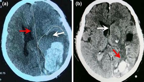 Hematoma Changes After Stereotactic Minimally Invasive Surgery A