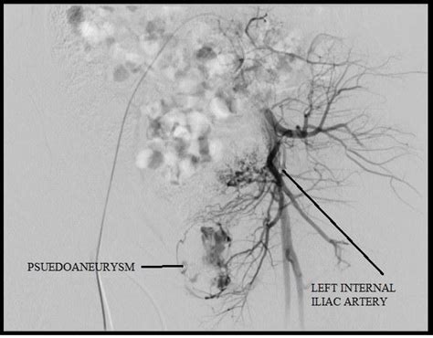 Digital Subtraction Angiography Image Of Right Internal Iliac Artery