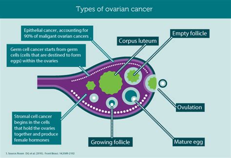 Ovarian Cancer Simplifiedmed