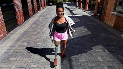 Rwandan Woman Who Lost Leg Aims To Help Other Amputees