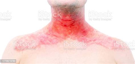 Atopic Dermatitis At Neck Stock Photo Download Image Now Istock