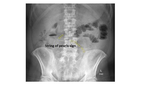 Imaging Case Of The Week 173 Answer Emergucate