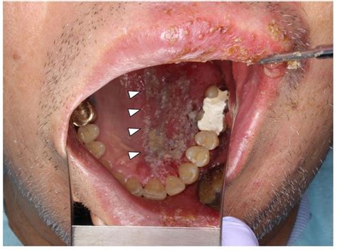 Oral shingles | BMJ Case Reports