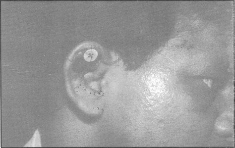 Classical Presentation Of Pseudocyst Of Auricle Rst Side Fig 2 Post