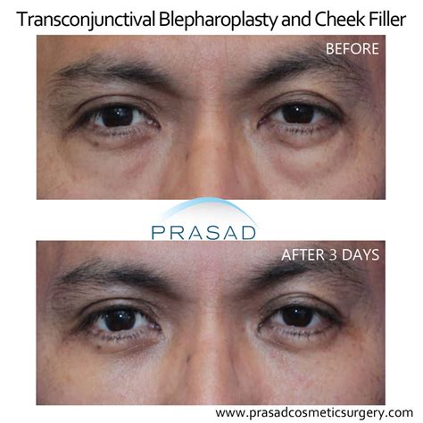 Lower Blepharoplasty Recovery Process Dr Prasad Blog