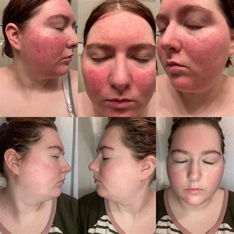This Is My Before And After Of Just A Month Using Metrogel For My Rosacea R Rosacea