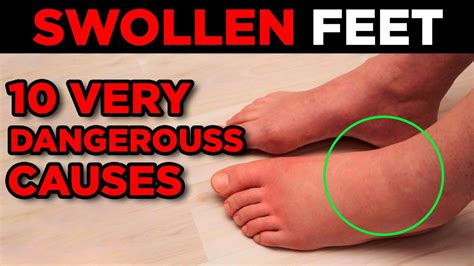 Swollen Feet Causes And Treatments For Swelling In The Feet And Legs