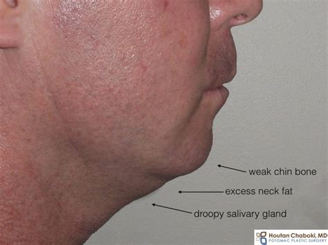 Double Chin Treatment Which Surgery Is Best Before And After Photos
