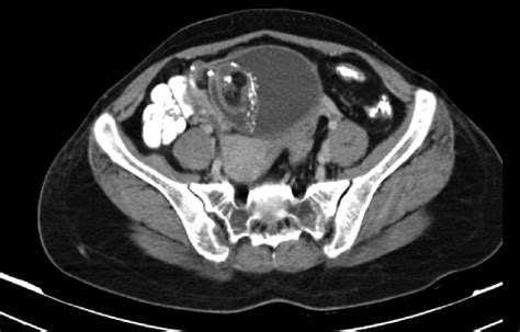 Contrast Enhanced Ct Scan Showing Heterogeneous Mass In The Right Dome