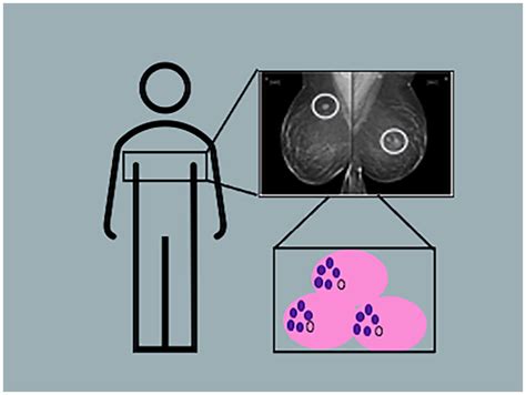 Bilateral Breast Rosai‐dorfman Disease Screen Detected By Mammography
