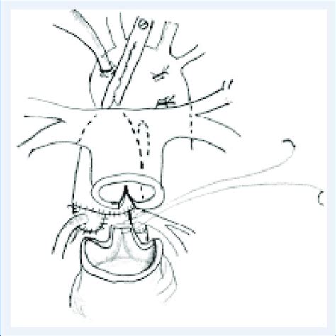 Schematic Drawing Of The Operative Technique The Distal Pulmonary