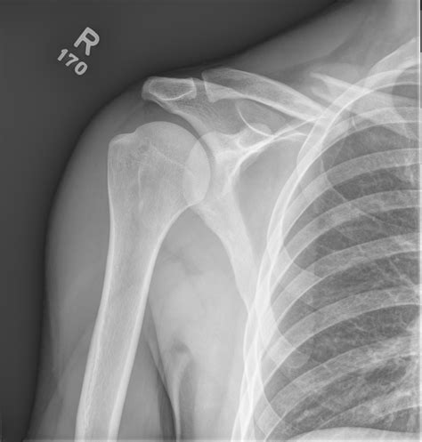 Clavicle Fractures Core Em