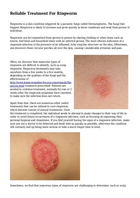 Reliable Treatment For Ringworm