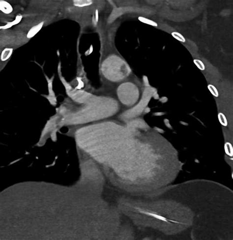 Clot In Aorta And Left Ventricle Cardiac Case Studies Ctisus Ct