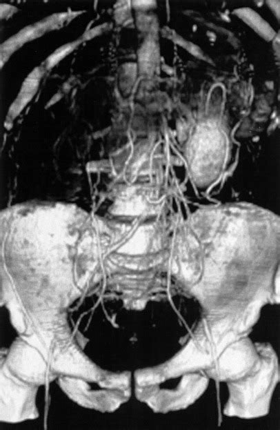 Hybrid Treatment For Juxtarenal Aortic Occlusion Successful