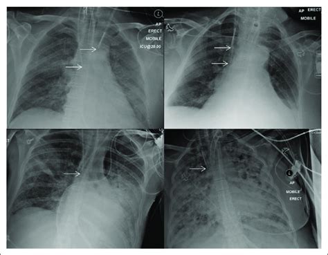 Chest X Rays Demonstrating Central Venous Catheters A Vrogue Co