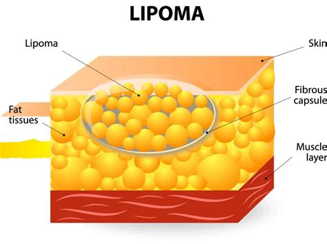 Lipoma A Fat Tumor Dtap Clinic