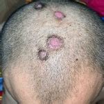 Unusual Clinical Manifestation Of Seborrheic Keratosis On The Scalp Successfully Treated With