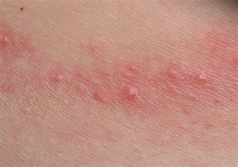 Common Causes Of Contact Dermatitis