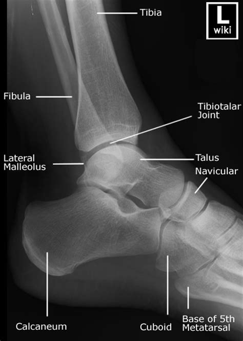 Emdocs Net Emergency Medicine Educationdiagnostic Accuracy Of Ankle X Rays How Often Do We