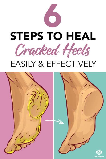 Follow These 6 Steps To Heal Cracked Heels Easily And Effectively