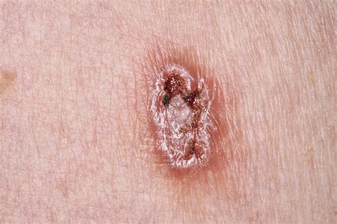 Ulcerated Basal Cell Carcinoma Stock Image C0401402 Science