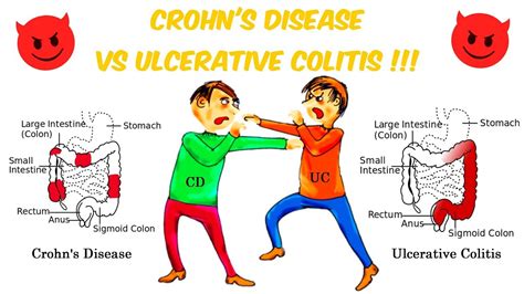 Crohns Vs Ulcerative Colitis The Battle Of The Bowels Youtube