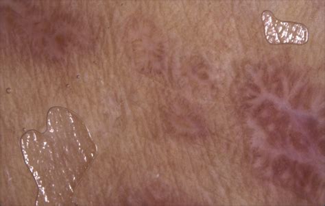 Dermoscopy Of Active Lichen Planus Dermatology Jama Dermatology