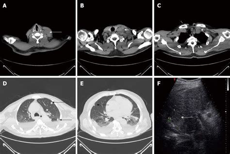 Supraclavicular Lymph Nodes Ultrasound Ultrasound Of Superficial