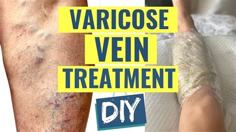 How To Treat Varicose Veins At Home Natural Varicose Vein Treatment