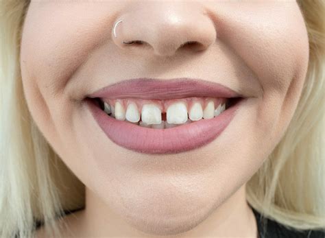 Causes And Treatment Options For Gap Teeth Diastema