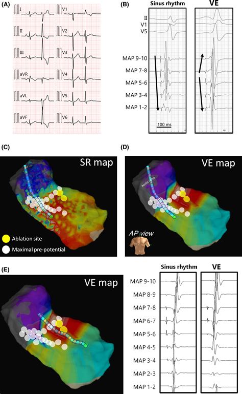 Successful cryoablation of ventricular extrasystoles originating from