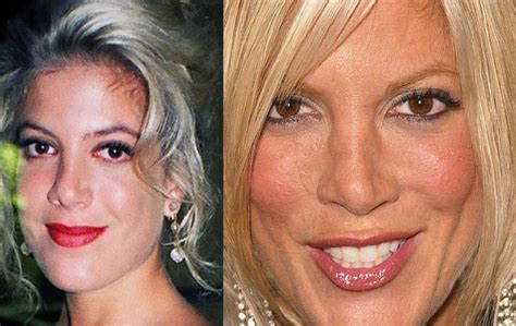 Celebrity Plastic Surgery Before Age 25