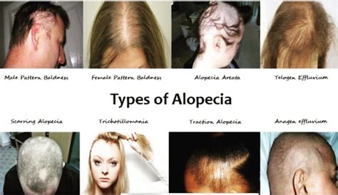 The Different Types Of Alopecia Hair Loss
