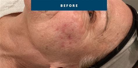 Dermatology Before And After Photos Franklin Dermatology Group