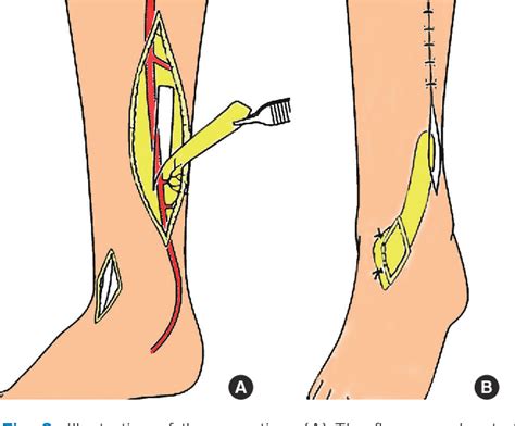 Posterior Tibial Artery Perforator Flap A Defect Located Over The My