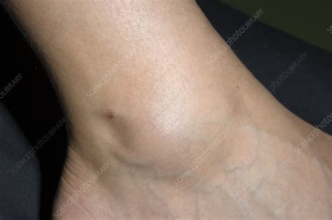 Swollen Ankle Stock Image M3301594 Science Photo Library