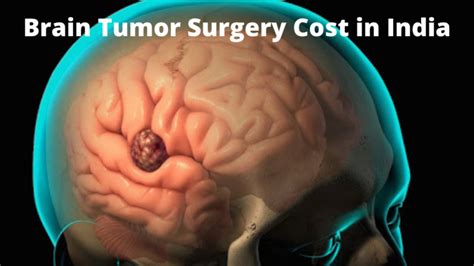 Best Brain Tumor Surgery Cost In India 2023 Medicare Spots