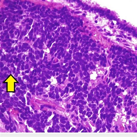 Carcinoid Tumor Lung Bronchial Biopsy Hematoxylin And Eosin Stain