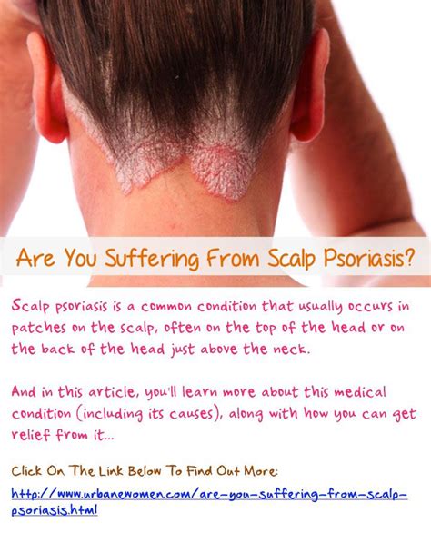 Are You Suffering From Scalp Psoriasis Scalp Psoriasis Is A Common