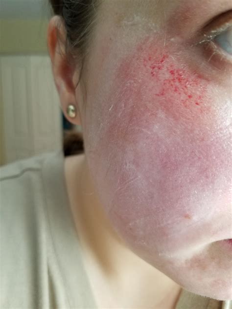 [skin concerns] rug burn on face how best to treat it skincareaddiction