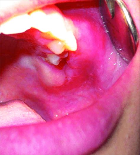 Intraoral Examination Revealing A Swelling Extending From Distal Of