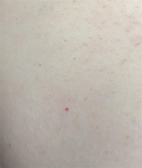 What Are These Little Red Dots On My Arms Dermatology