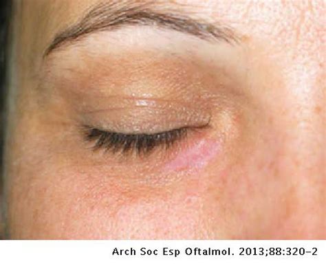 Application Of Laser Co2 For The Treatment Of Xanthelasma Palpebrarum